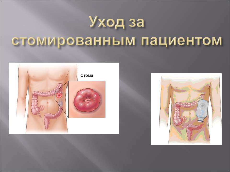 Уход за стомированным пациентом - Класс учебник | Академический школьный учебник скачать | Сайт школьных книг учебников uchebniki.org.ua